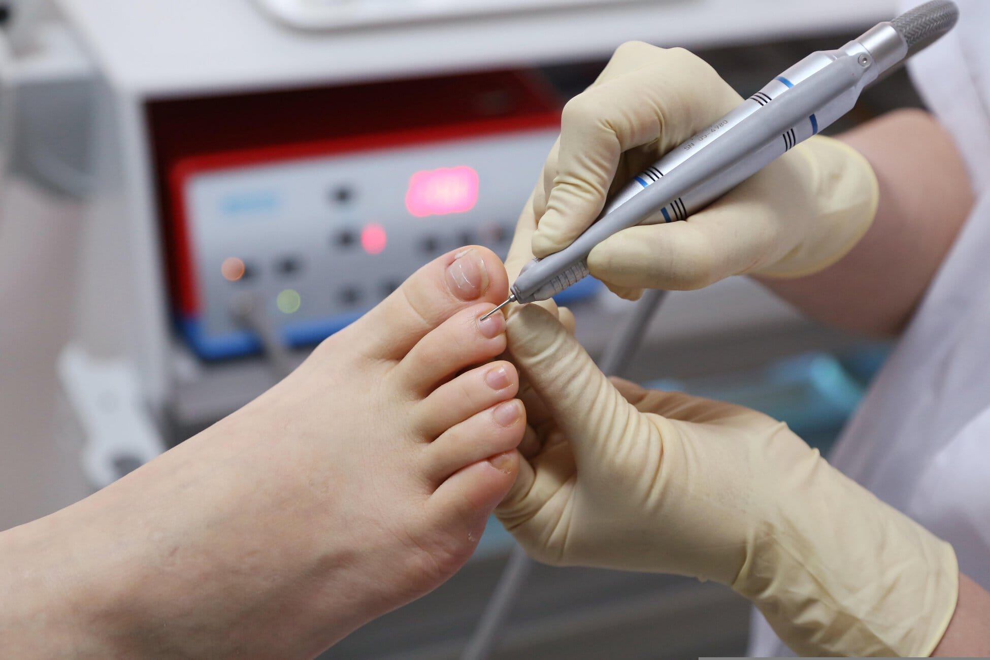 775919 – Mercedes Palomo Podología Medical professional wearing gloves treating a patient’s toe with a handheld instrument for foot care.